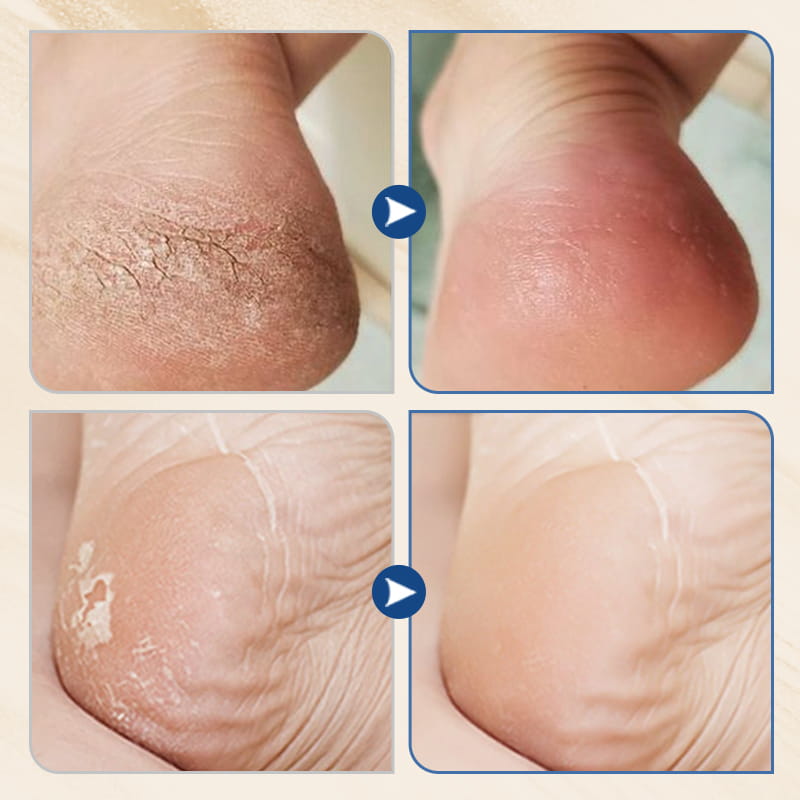 🔥HOT SALE🔥Hydrating and Anti-Cracking Foot Cream